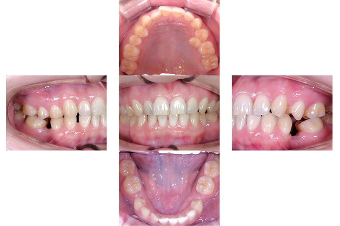 マウスピース型矯正装置（インビザライン）による全顎矯正治療 before