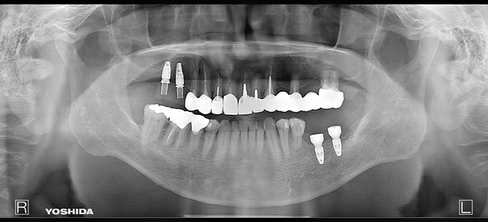 インプラント レントゲン after