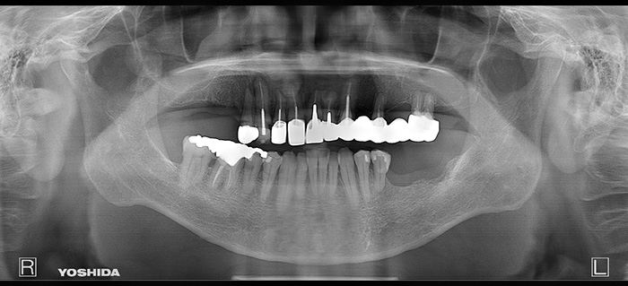 インプラント レントゲン before