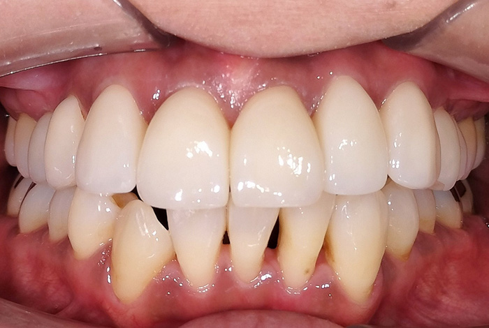 ラミネートベニア after