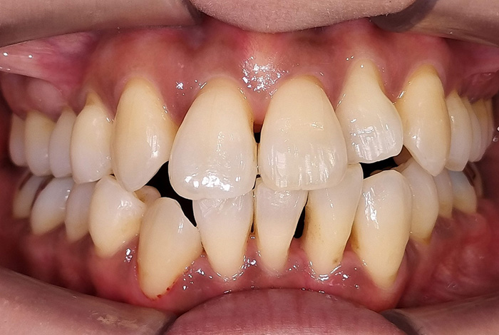 ラミネートベニア before