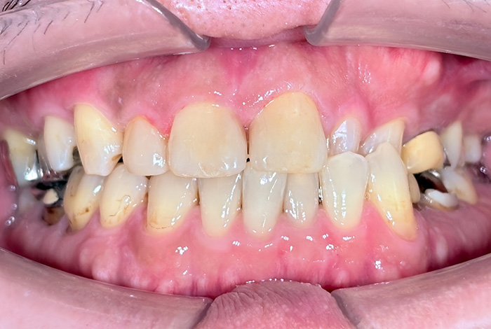 ダイレクトボンディング after