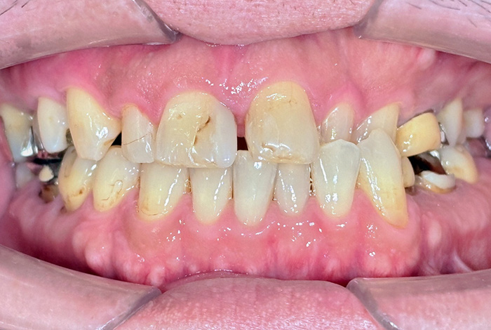 ダイレクトボンディング before