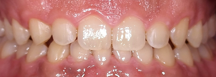 マウスピース型矯正装置（インビザライン）によるディープバイト改善症例 after