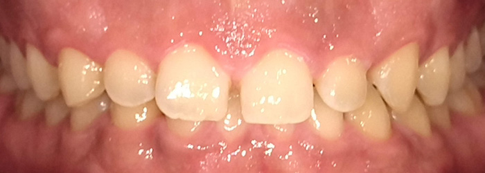 マウスピース型矯正装置（インビザライン）によるディープバイト改善症例 before