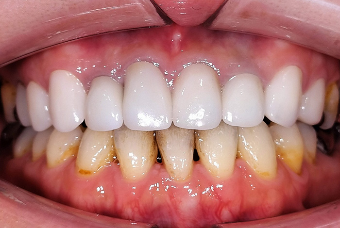 オフィスホワイトニング before