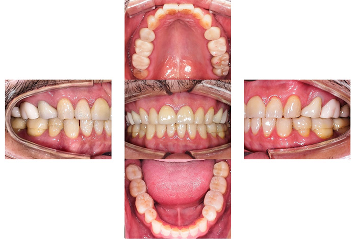 ジルコニアクラウン＋ラミネートベニア after