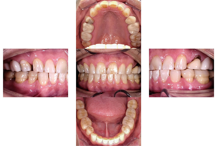 ジルコニアクラウン＋ラミネートベニア before