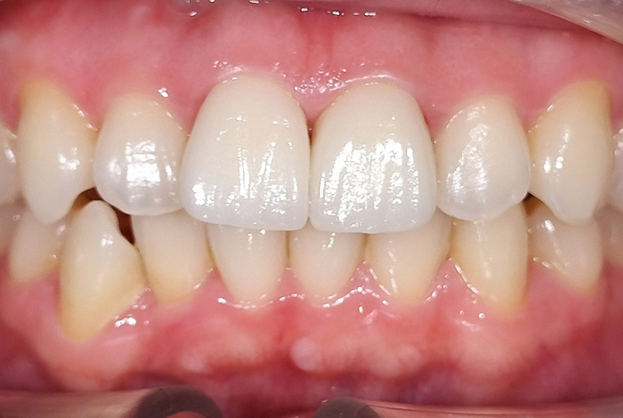 ジルコニアプレミアムクラウン after