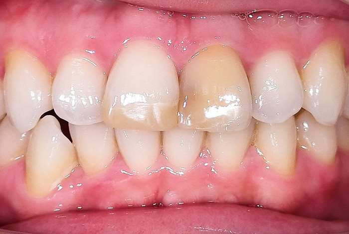 ジルコニアプレミアムクラウン before