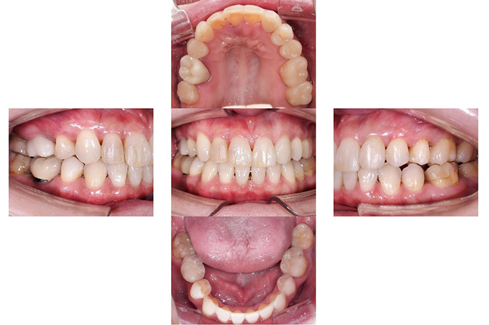 インビザライン＋ジルコニア after