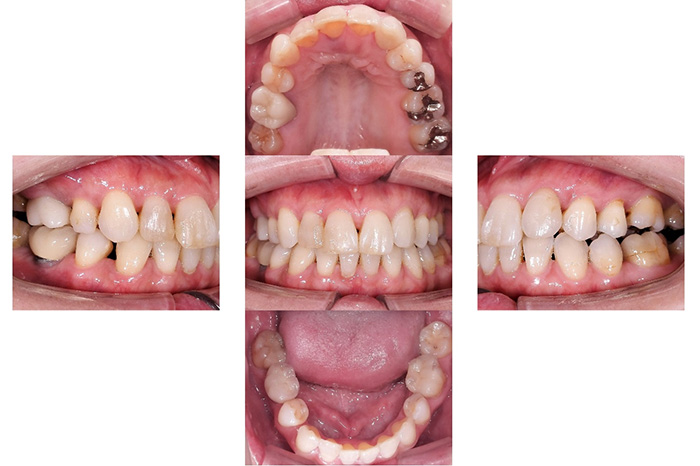 インビザライン＋ジルコニア before