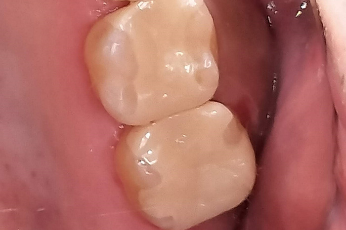 ジルコニアインレー after