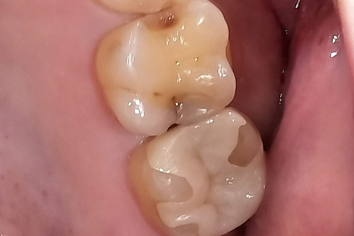 ジルコニアインレー before