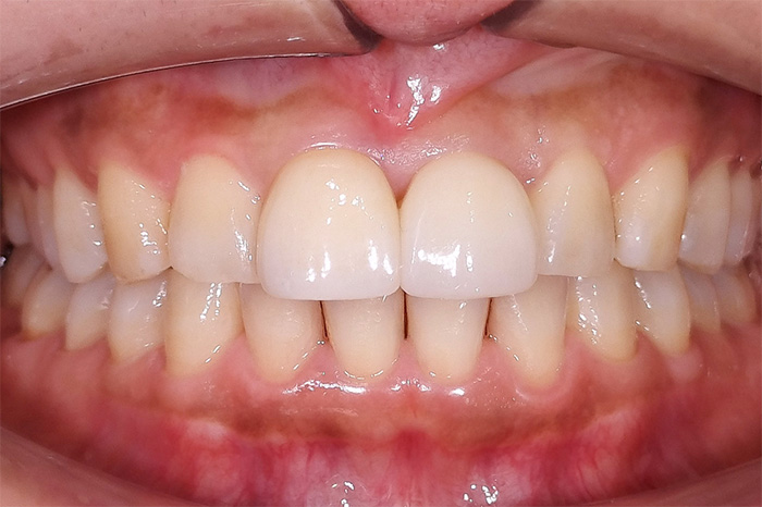前歯の変色と摩耗による長さの不ぞろい改善 after