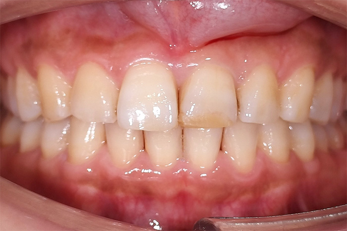 前歯の変色と摩耗による長さの不ぞろい改善 before