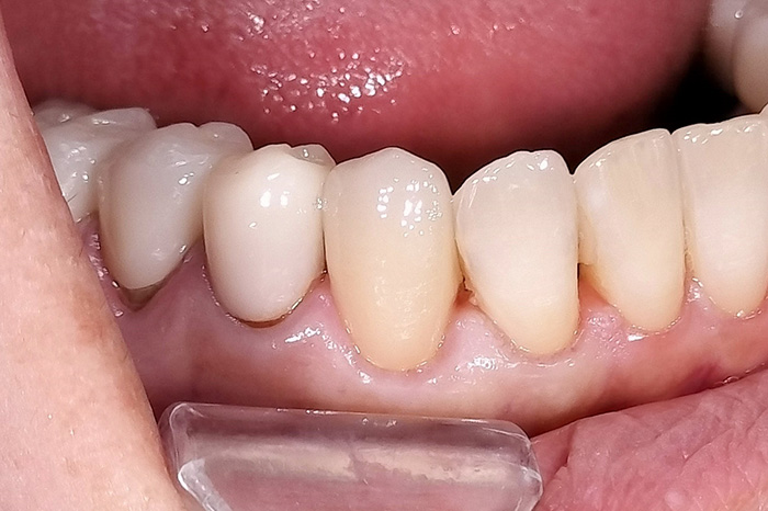 古い被せ物の変色と歯ぐきの下がりをe-maxクラウンで改善した症例 after