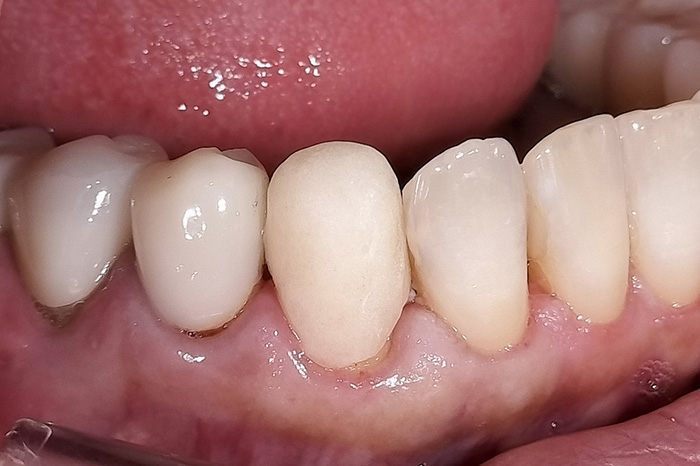 古い被せ物の変色と歯ぐきの下がりをe-maxクラウンで改善した症例 before