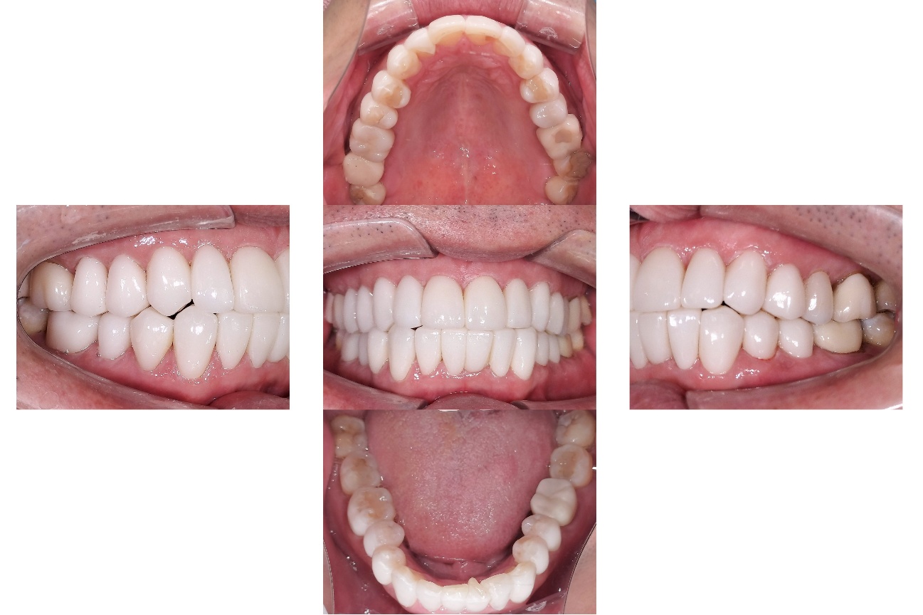 ジルコニアラミネートベニア after