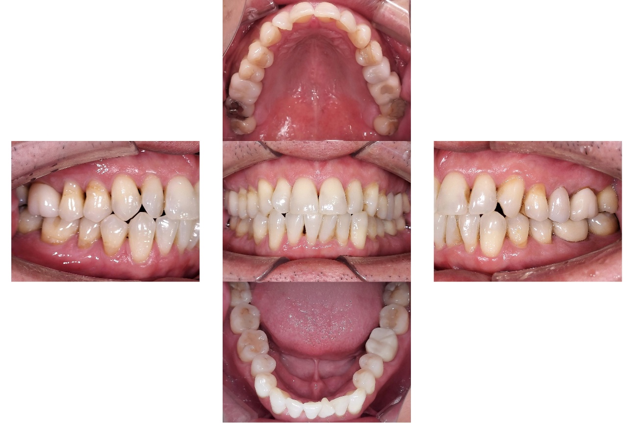 ジルコニアラミネートベニア before