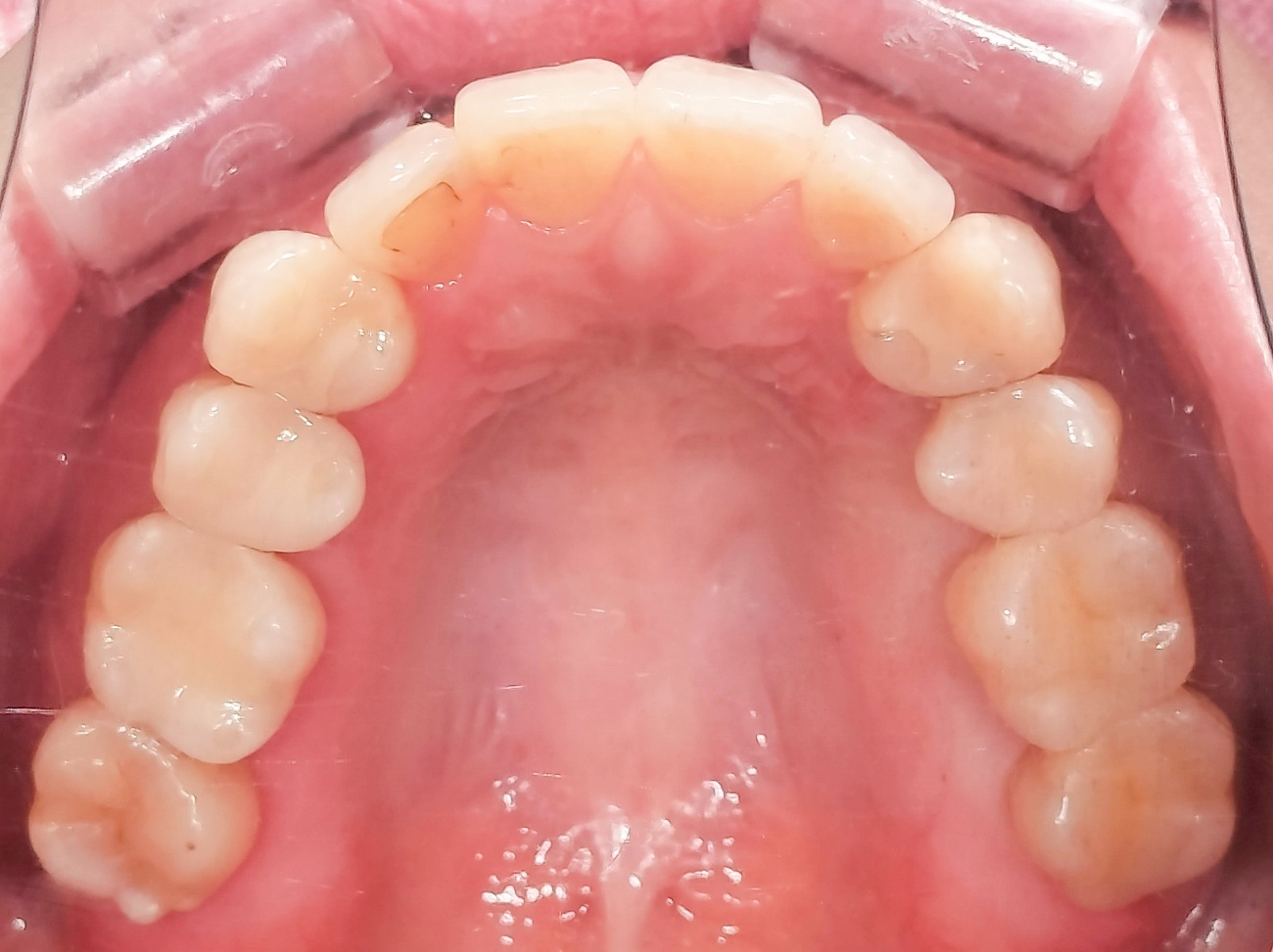 e-maxインレー after