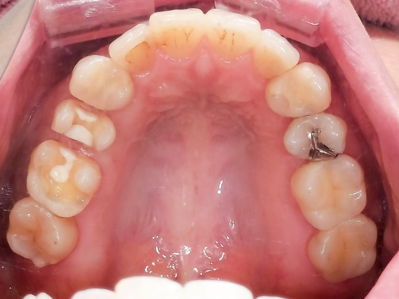 e-maxインレー before