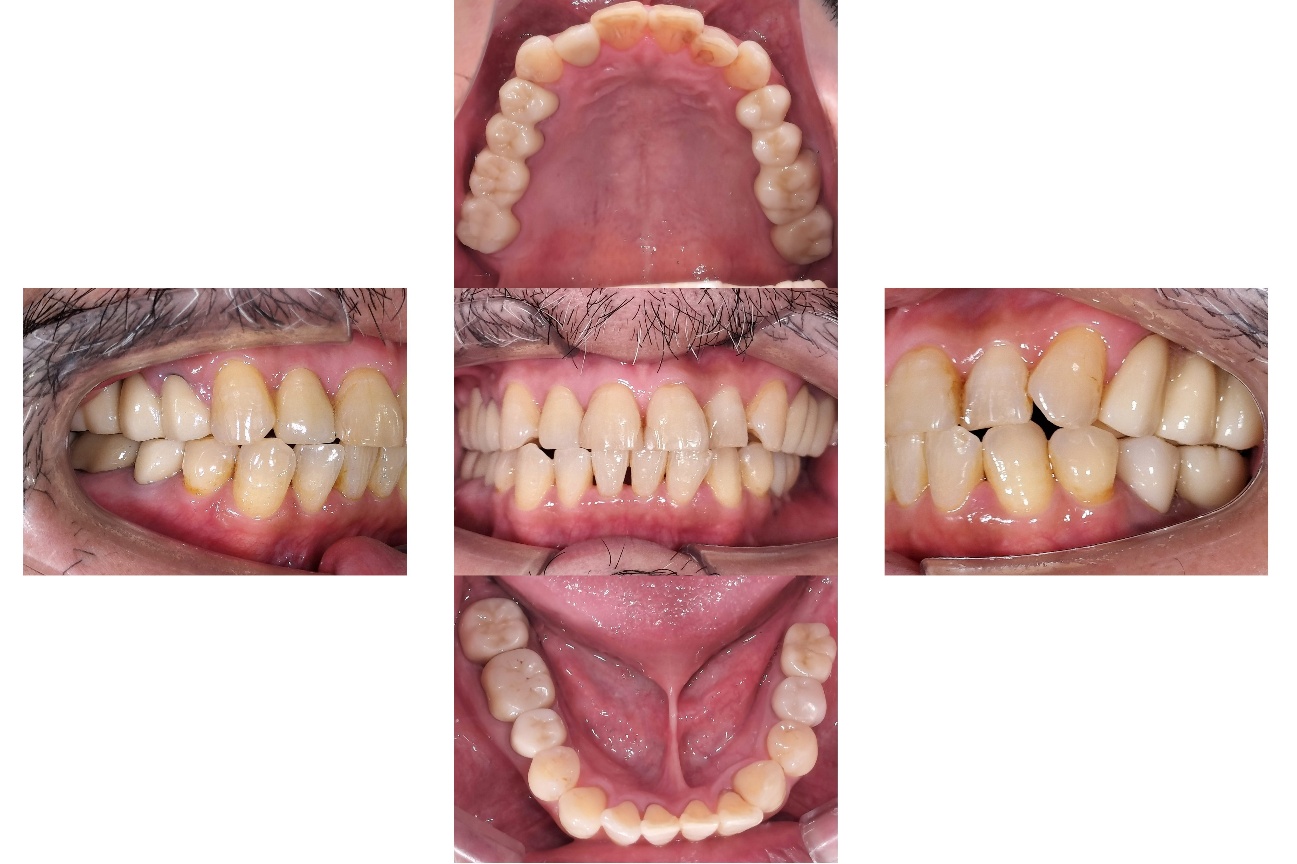 審美・インプラント複合治療 after