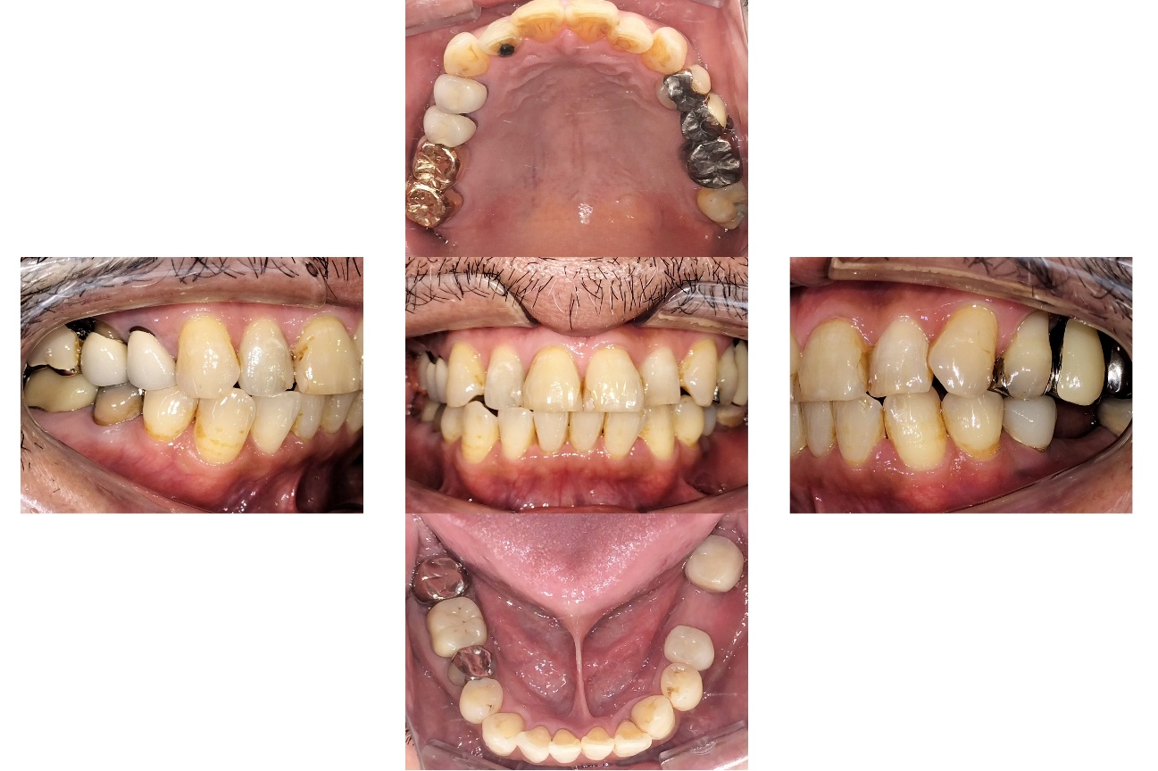 審美・インプラント複合治療 before