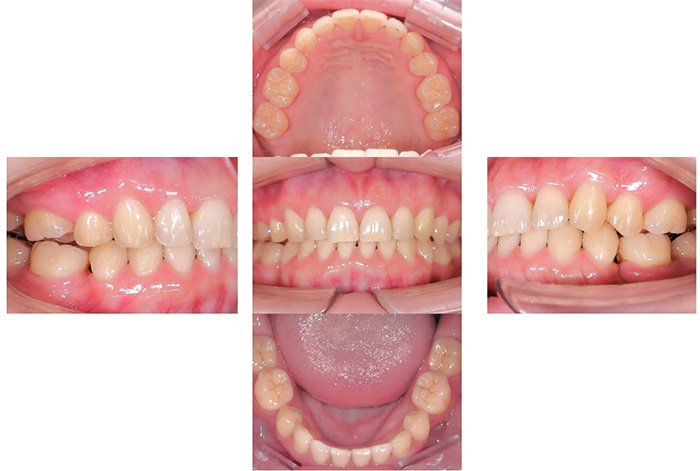 マウスピース型矯正装置（インビザライン）after