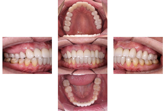 インビザライン全体矯正＋補綴治療（コンビネーション治療症例）after