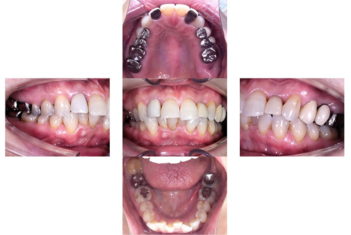 インビザライン全体矯正＋補綴治療（コンビネーション治療症例）before