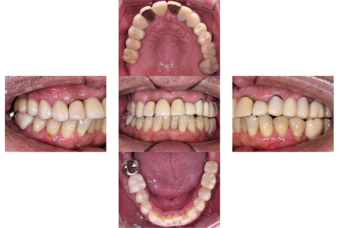 インプラント after