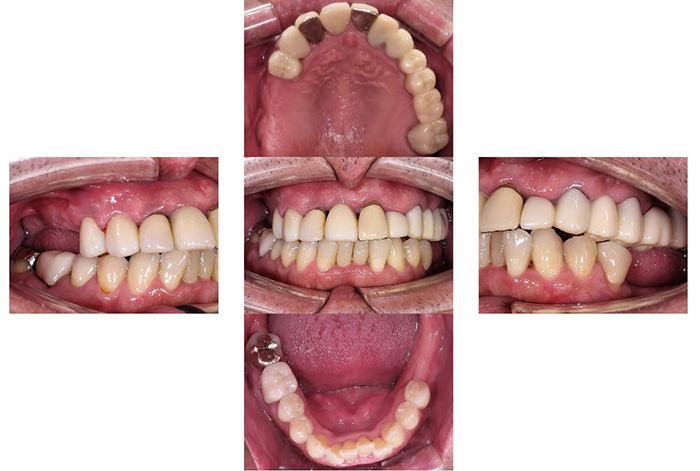 インプラント before